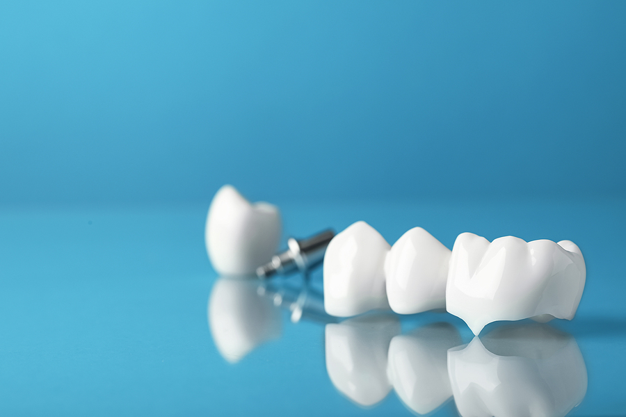 Things to Know about Dental Crowns